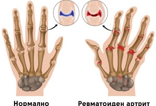 Ревматоиден-артрит