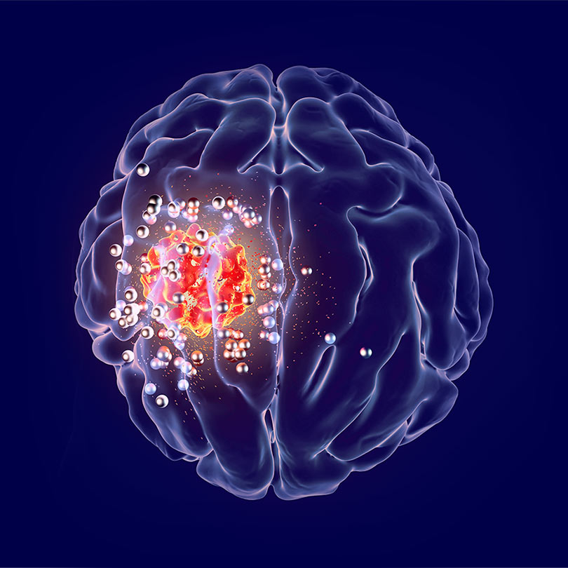 Мозъчните метастази изчезват в резултат на Водородната Терапия