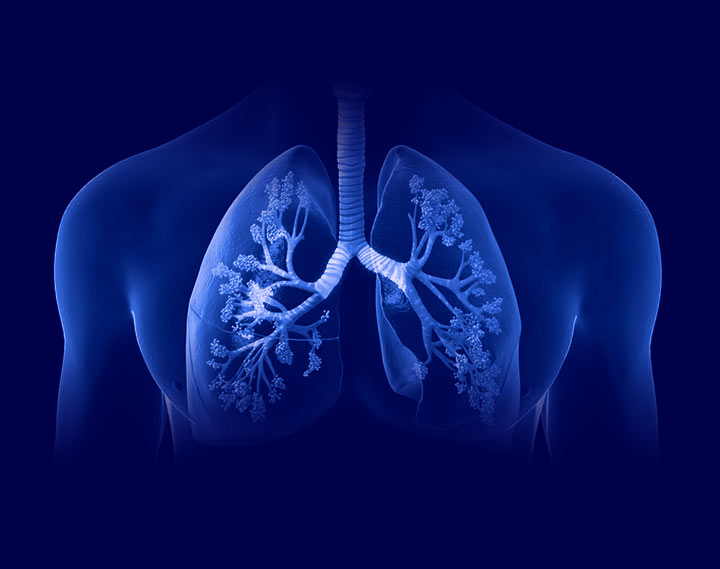 Лечение на ХОББ (рентген на бели дробове)