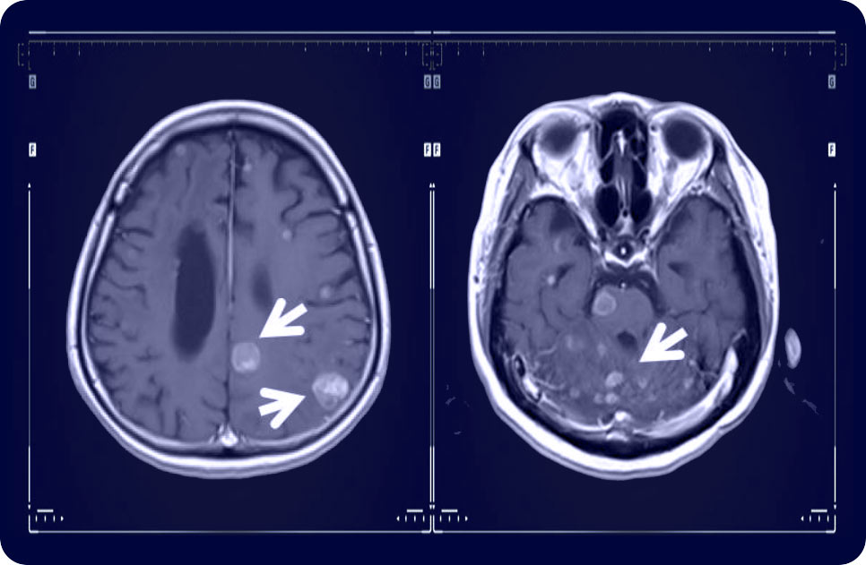 Метастази в мозъка (фигура 1)