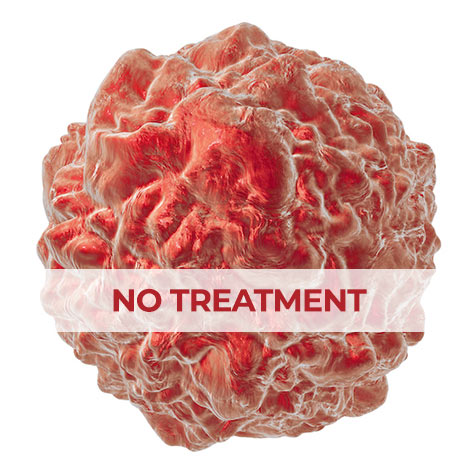 Hydrogen-Therapy-Colon-Cancer-Colorectal-Carcinoma_Tumor-1_MBL Colon Cancer (Colorectal Carcinoma) Tumor Size