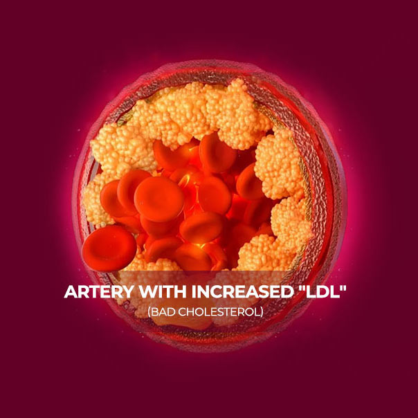 increased-ldl-bad-cholesterol-MB